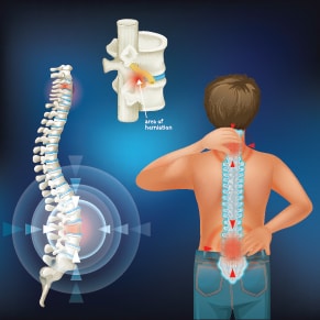 All You Should Know About Spinal Cord Injury 